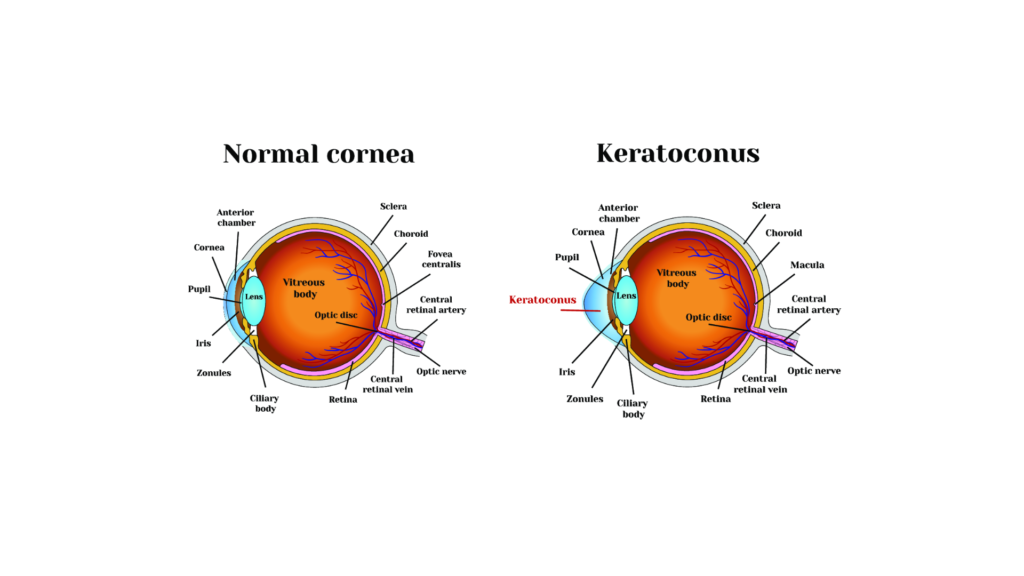 Vad är Keratoconus