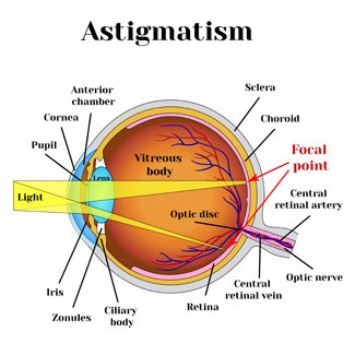 Illustration som beskriver olika delar av ögat med astigmatism